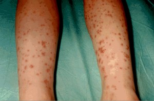 兒童過敏性紫癜