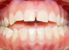 齒齦肥厚 齒齦肥厚