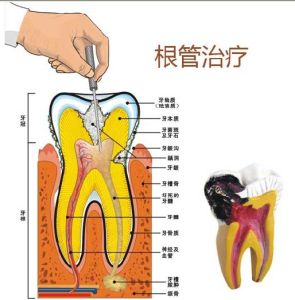 急性牙髓炎
