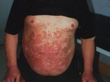 皮膚阿米巴病 皮膚阿米巴病