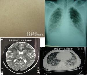 脂肪栓塞綜合徵 脂肪栓塞綜合徵