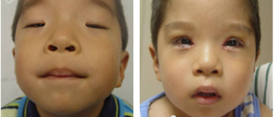 先天小瞼裂綜合症 先天小瞼裂綜合症