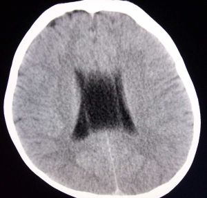 透明隔囊腫 透明隔囊腫