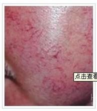 遺傳性紅血絲 遺傳性紅血絲