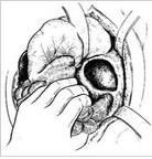 膈疝修補術 膈疝修補術
