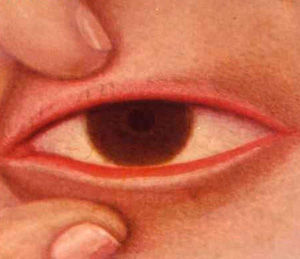潰瘍性瞼緣炎