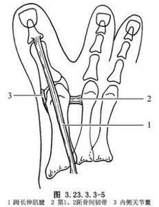 拇內翻手術 拇內翻手術
