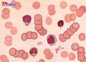 巨球蛋白血症