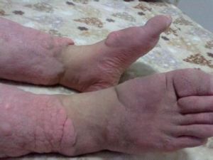 脛前粘液性水腫 脛前粘液性水腫