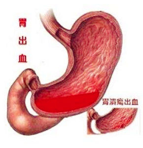 胃穿孔