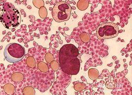 抗鹼血紅蛋白試驗 抗鹼血紅蛋白試驗