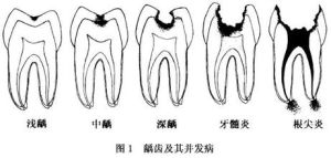 小兒齲病 小兒齲病