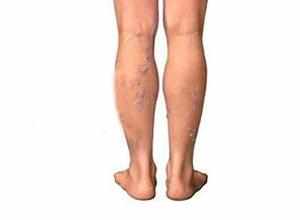 下肢淺靜脈曲張 下肢淺靜脈曲張