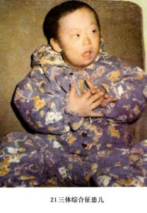 21三體綜合症
