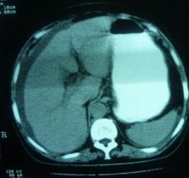 胰腺CT檢查 胰腺CT檢查