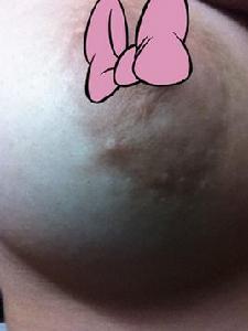 雙乳腺小葉增生 雙乳腺小葉增生