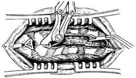 腰椎椎管狹窄 腰椎椎管狹窄