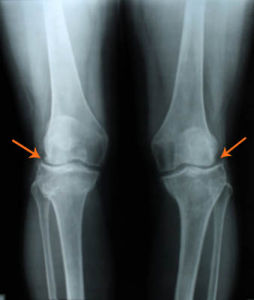 髕骨關節炎 髕骨關節炎