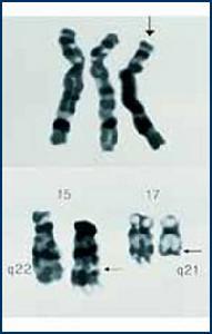 急性淋巴細胞性白血病染色體易位