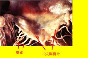 二尖瓣脫垂綜合症