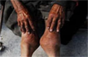 小兒卡斯欽-貝克病 小兒卡斯欽-貝克病