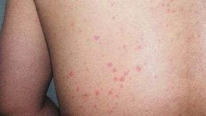 膽鹼蕁麻疹