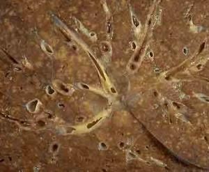 空洞型肺結核 空洞型肺結核