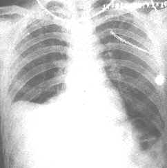類肺炎性胸腔積液