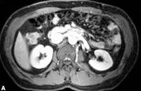 慢性腎衰竭 慢性腎衰竭