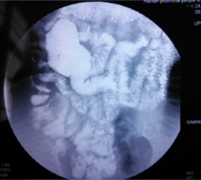 全消化道造影 全消化道造影