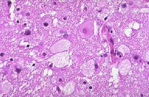 （圖）病理表現