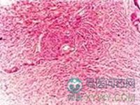 瀰漫性嬰兒纖維瘤病 瀰漫性嬰兒纖維瘤病