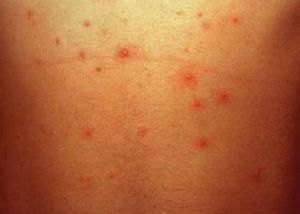 Kaposi水痘樣疹 Kaposi水痘樣疹