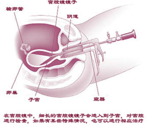 宮腔鏡檢查 宮腔鏡檢查