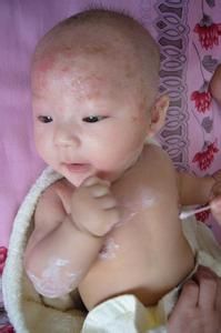 嬰兒濕疹 嬰兒濕疹