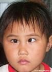 小兒內斜視 小兒內斜視