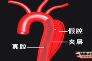 胸主動脈瘤