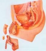 盆腔結締組織炎 盆腔結締組織炎