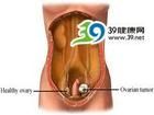 小兒卵巢腫瘤
