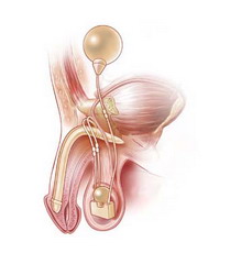 陰莖假體植入術 陰莖假體植入術