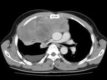 小兒橫紋肌肉瘤 小兒橫紋肌肉瘤