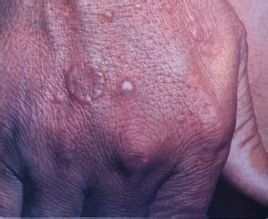 環狀肉芽腫 環狀肉芽腫