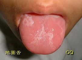 小兒病毒感染性口炎