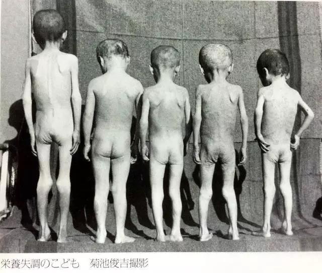 (日本東京昭和館中的圖片，戰爭後期的日本缺乏食物，兒童營養失調)