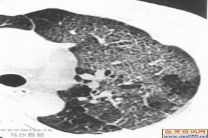 卡氏肺孢子蟲病