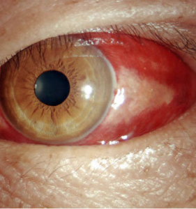 結膜下出血 結膜下出血