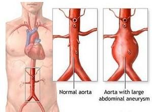 腹主動脈瘤腔內修復術 腹主動脈瘤腔內修復術