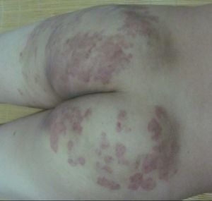 腹股溝癢 腹股溝癢