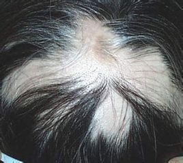 永久性脫髮 永久性脫髮