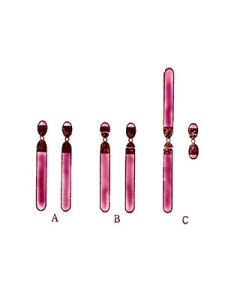 染色體易位 染色體易位